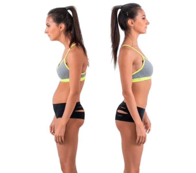 Гіперлордоз