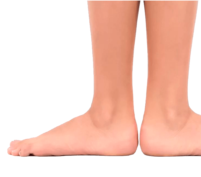 Плоскостопість